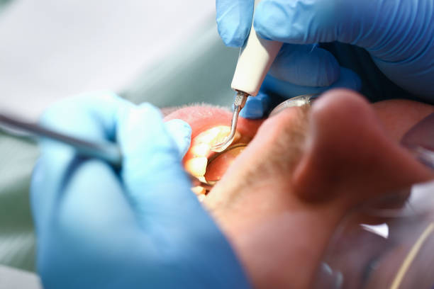 Best Emergency Tooth Extraction in Lexington, NE