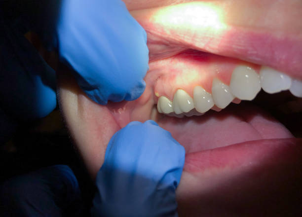 Best Emergency Tooth Extraction in Lexington, NE